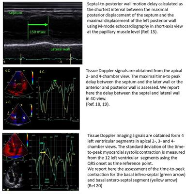 Frontiers | The Saga Of Dyssynchrony Imaging: Are We Getting To The Point